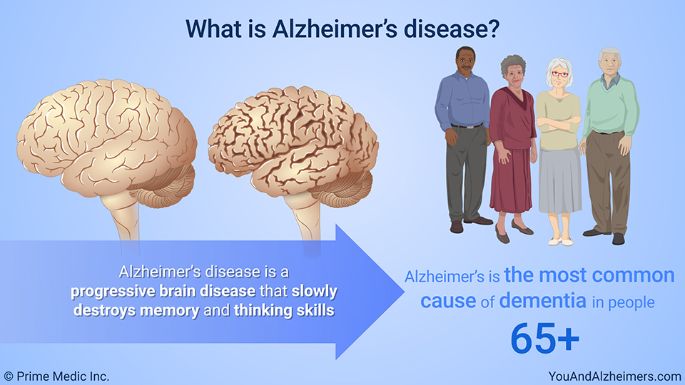 What is Alzheimer's disease? 