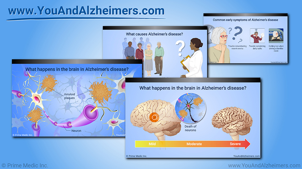 Slide Show - Understanding Alzheimer's Disease