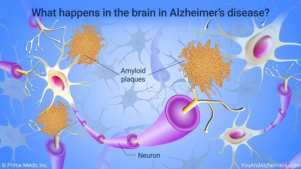 What happens in the brain in Alzheimer's disease?