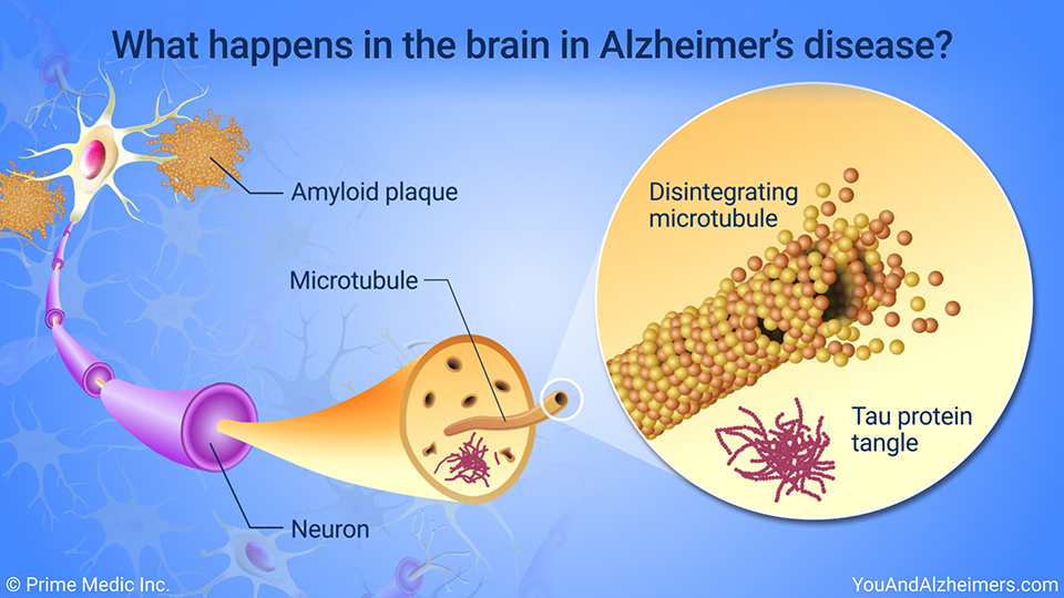 What happens in the brain in Alzheimer's disease?